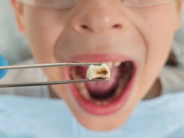 Best Broken or Chipped Tooth Repair in Hauser, ID